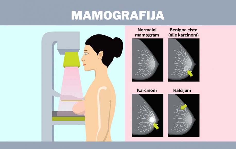 Превентивни преглед - мамографија
