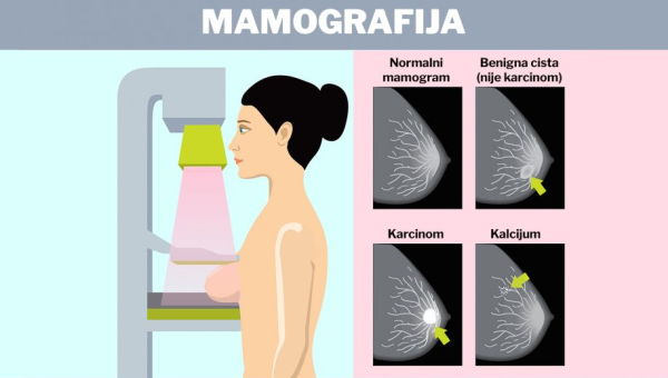 Превентивни преглед - мамографија